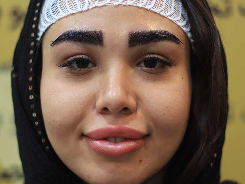 eyebrow-transplant-karaj