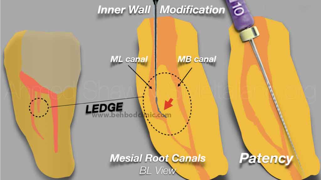 فرق عصبکشی با ری اندو چیست