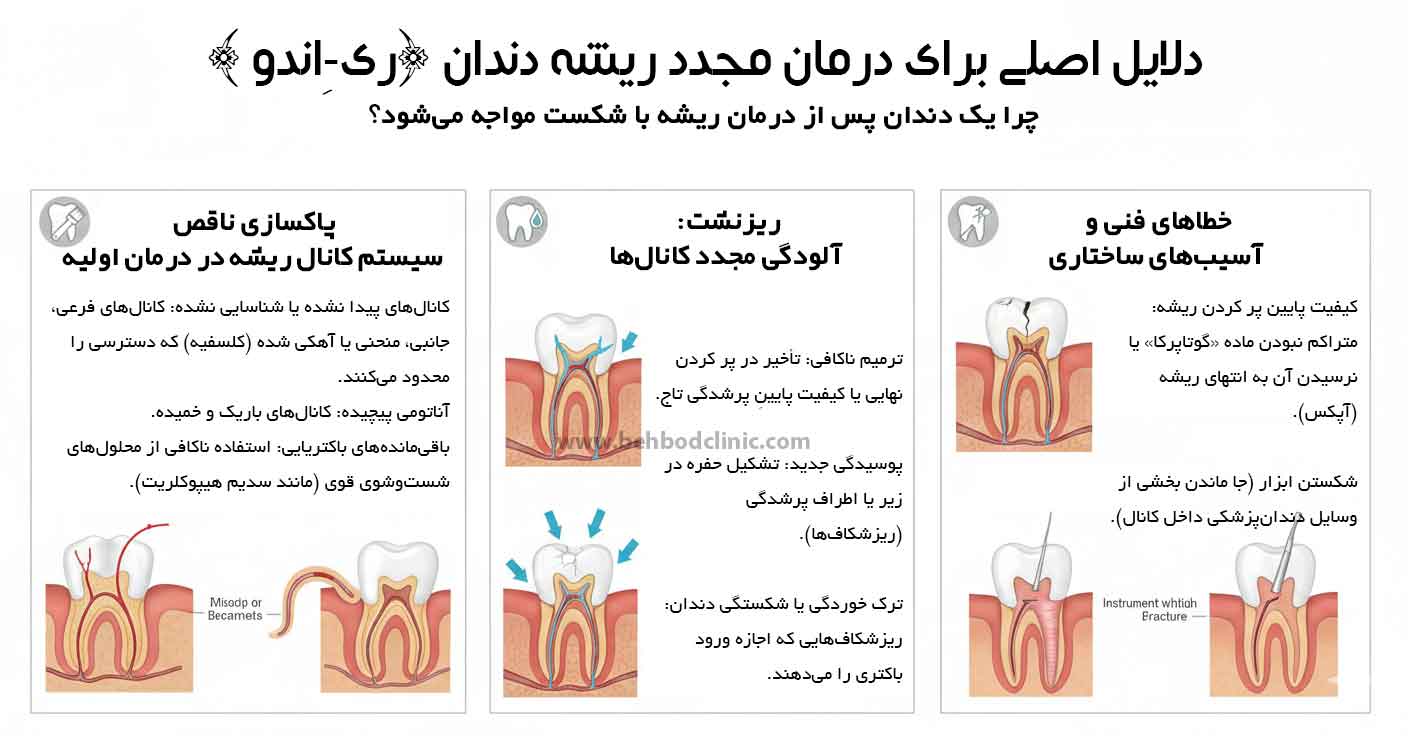 عصب کشی مجدد دندان یا ری اندو
