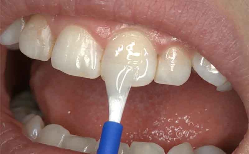 فلوراید تراپی کودکان