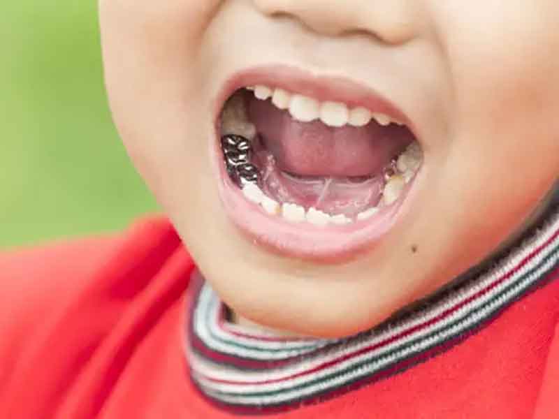 پالپوتومی دندان شیری کودکان